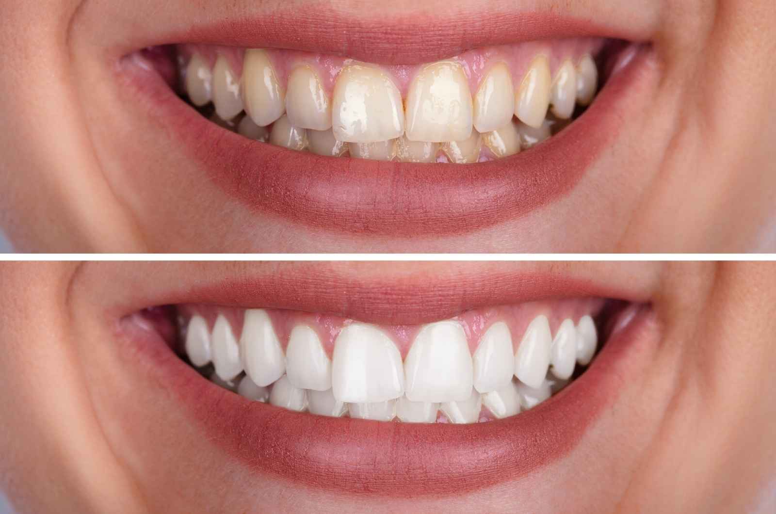 כיצד ניתן להלבין שיניים לצמיתות? ‏
